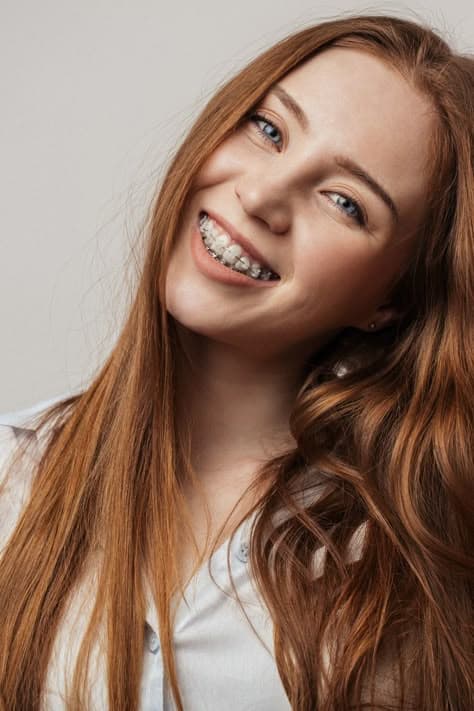 Ceramic Braces