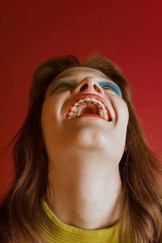 Lingual Braces